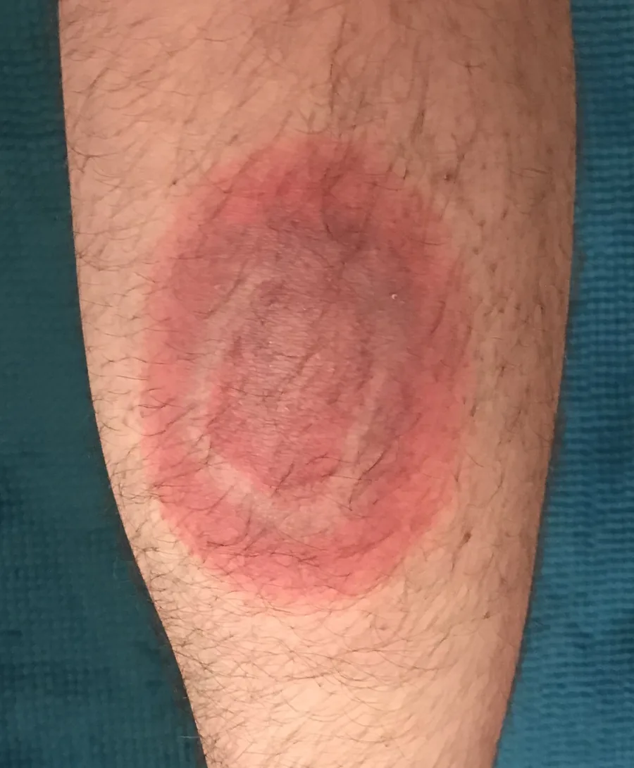Bull's-eye rash (erythema migrans) - sign to seek medical attention immediately