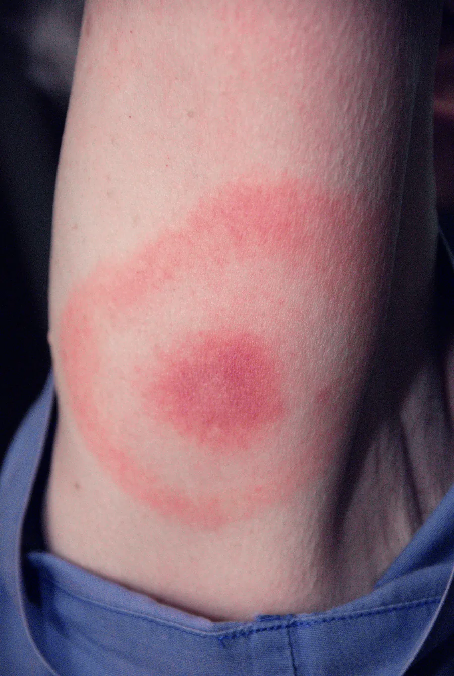 Bull's-eye rash (erythema migrans) from tick-borne Lyme disease